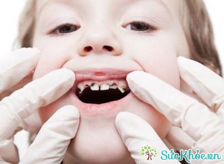 Hình ảnh bệnh sâu răng ở trẻ em