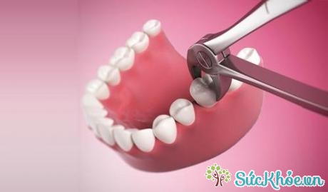 Sau khi răng sâu được nhổ đi sẽ được thay thế bằng răng sứ