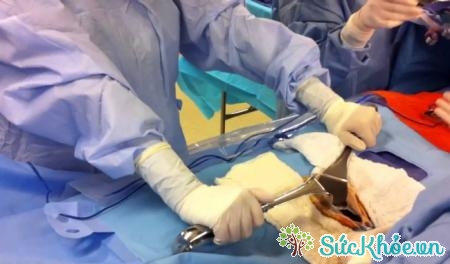 Phẫu thuật cắt túi mật giúp điều trị sỏi mật