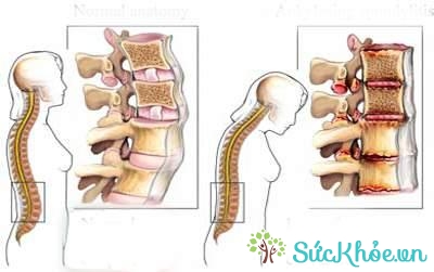 Điều trị viêm cột sống dính khớp