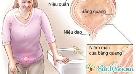 Đau bụng dưới ở phụ nữ có thể là do bệnh viêm bàng quang gây ra