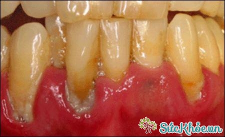 Vôi răng là sự xuất hiện của các mảng bám quanh nướu răng