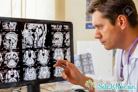 Phân biệt bệnh Parkinson và hội chứng Parkinson bằng cách quét não MRI 