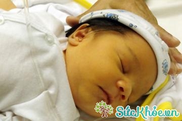 Vàng da ở trẻ sơ sinh thường sốt cao, ngủ li bì, bú ít