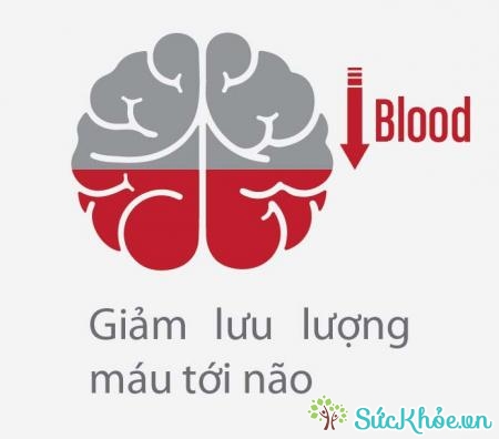 Thiếu máu não là tình trạng giảm lưu lượng máu đến não