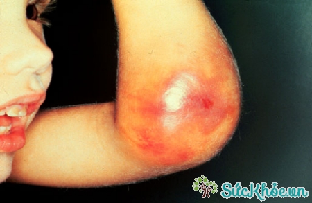 Bệnh máu khó đông là bệnh hiếm gặp