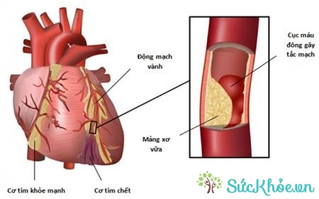 Xơ vữa động mạch là nguyên nhân gây bệnh động mạch vành