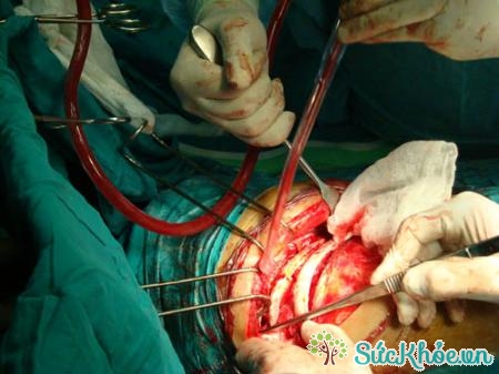 Sử dụng phương pháp phẫu thuật mở lồng ngực để điều trị thông liên thất