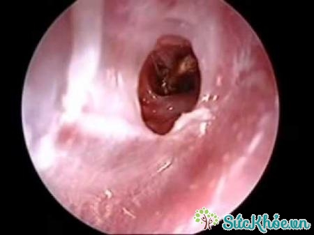 Triệu chứng dị vật trong tai