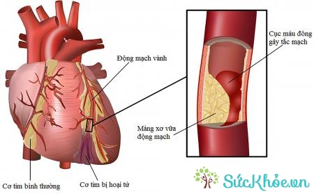 Cholesterol máu cao cũng gây bệnh tim