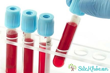 Chẩn đoán ung thư thực quản bằng xét nghiệm máu