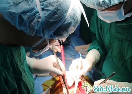 Nhiều bệnh nhân phải phẫu thuật thay thế một phần động mạch chủ