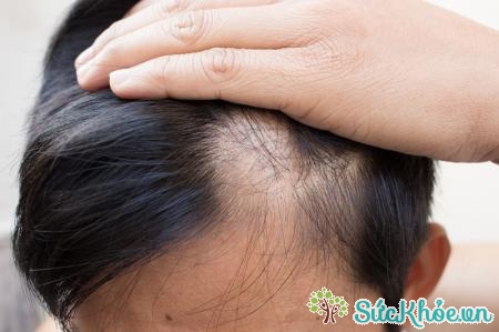 Triệu chứng có thể gặp đó là tóc thưa dễ rụng