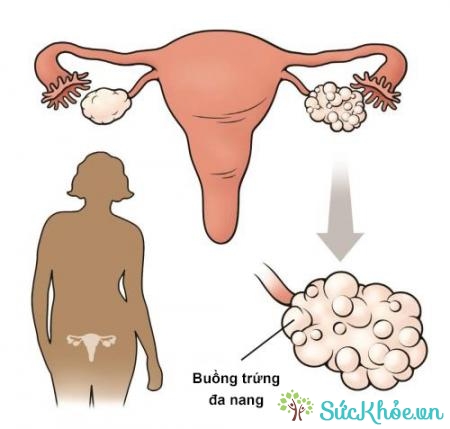 Đa nang buồng trứng là một rối loạn nội tiết phổ biến ở nữ giới