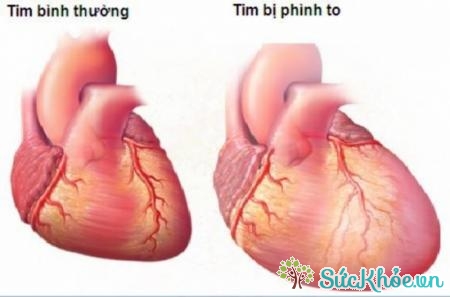 Tim to là triệu chứng viêm cơ tim do thâp tim