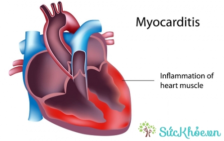 Viêm cơ tim là một trong những biến chứng thấp tim