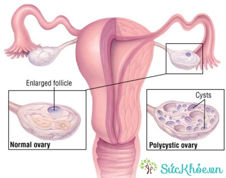 Hội chứng đa nang buồng trứng còn được gọi là bệnh đa nang buồng trứng