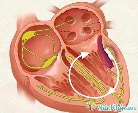 Điều trị viêm cơ tim cũng giúp điều trị thấp tim hiệu quả