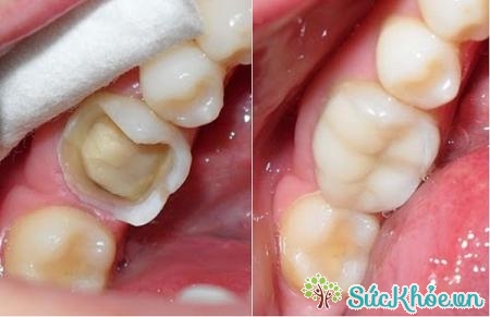 Chất trám răng cũng có thể gây vàng răng
