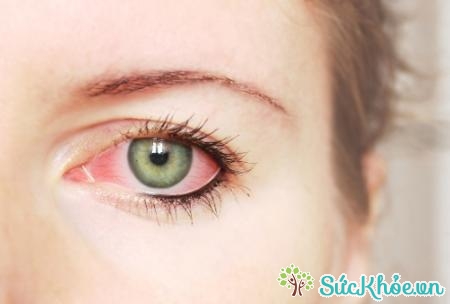 Đau mắt đỏ là một trong các loại đau mắt thường gặp khi giao mùa