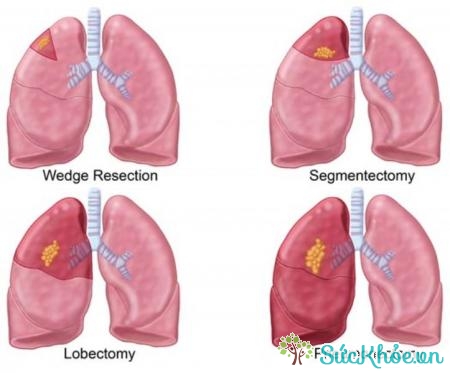 Xẹp phổi là biến chứng hen phế quản thường gặp