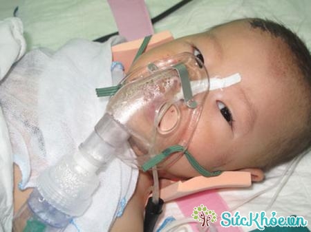 Trẻ sẽ được thở oxy nếu phát hiện mắc bệnh suy hô hấp