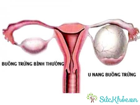 U nang buồng trứng gây vô sinh ở nữ