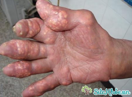 Hạt tophi là biến chứng của bệnh gout rất nguy hiểm
