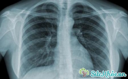 Hang lao có thể là ổ chứa vi khuẩn áp-xe phổi