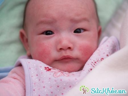 Trẻ sơ sinh là đối tượng dễ mắc bệnh Eczema