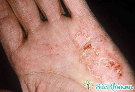 Eczema là một trạng thái viêm lớp nông của da