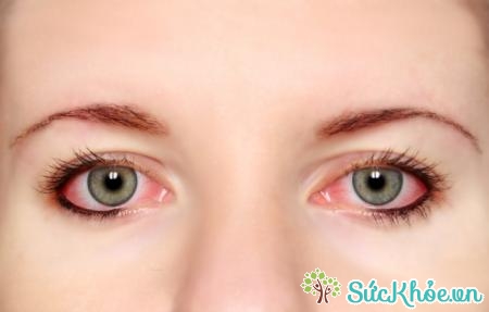 Đau mắt đỏ là bệnh thường gặp vào thời điểm giao mùa