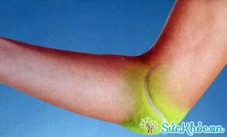 Hội chứng Tennis Elbow là nguyên nhân tê tay hàng đầu ở những người chơi tennis thường xuyên