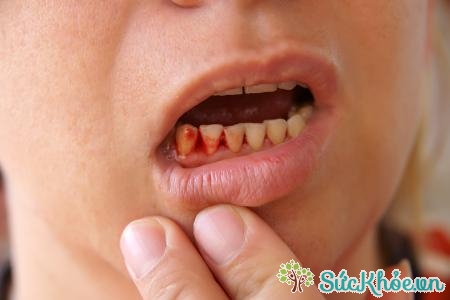 Nhiễm trùng ở nướu răng cũng sẽ gây hôi miệng