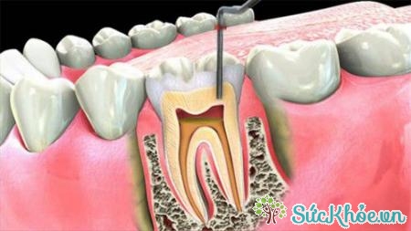 Bệnh tủy răng thông thường là biến chứng của sâu răng