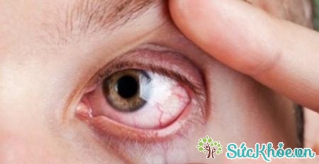 Tăng nhãn áp là một bệnh lý ở mắt