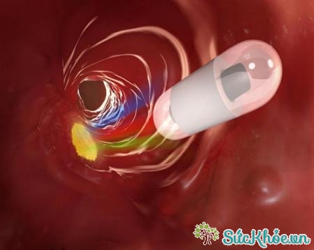 Nội soi viên nang không có khả năng điều trị can thiệp