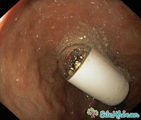 Nội soi viên nang là kỹ thuật nội soi ruột non bằng cách uống viên nang