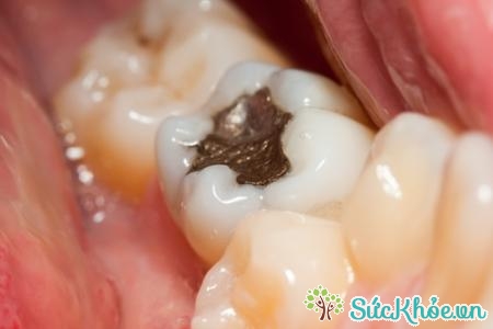 Một trong những nguyên nhân gây bệnh là do sâu răng