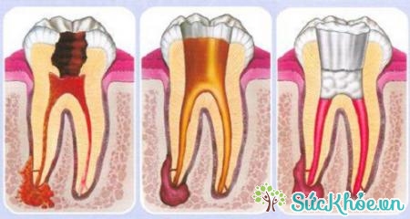 Biến chứng của bệnh tủy răng có thể gây chết tủy