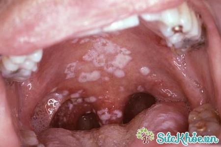 Nấm miệng là bệnh thường xảy ra nhiều ở trẻ nhỏ