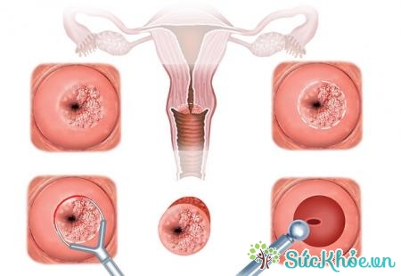 Viêm cổ tử cung là tình trạng cổ tử cung bị viêm nhiễm
