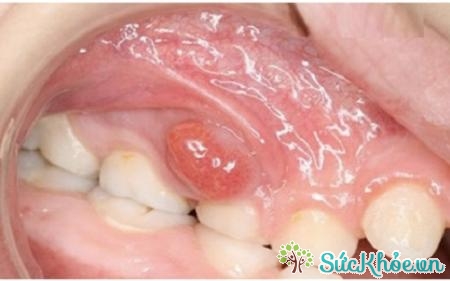 Bệnh u răng có thể hình thành do vệ sinh răng miệng kém