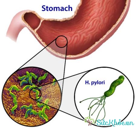 Nguyên nhân viêm tá tràng là do vi khuẩn Helicobacter pylori 