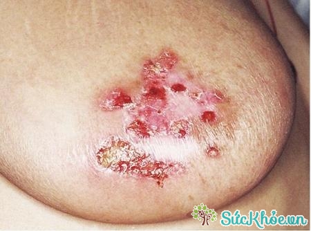 Bệnh paget vú là một dạng hiếm gặp của ung thư vú