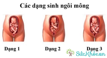 Khi sinh, nếu phần chân, gối ra trước sẽ được gọi là ngôi thai ngược
