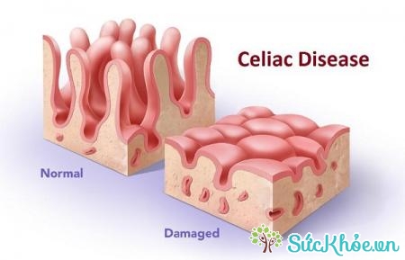 Dị ứng với glutenlà tên gọi chung của một nhóm bệnh bao gồm cả bệnh celiac 