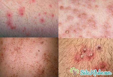 Một số hình ảnh bệnh viêm nang lông