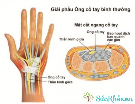 Hội chứng ống cổ tay là một nguyên nhân đau cánh tay thường gặp