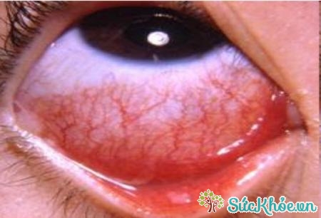 Viêm giác mạc là một trong các dạng dị ứng mắt